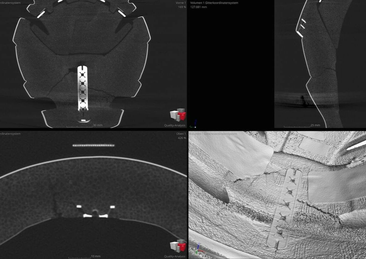 Risse am Inneren eines Skihelms nach Sturz. Darstellung mittels CT-Scan.