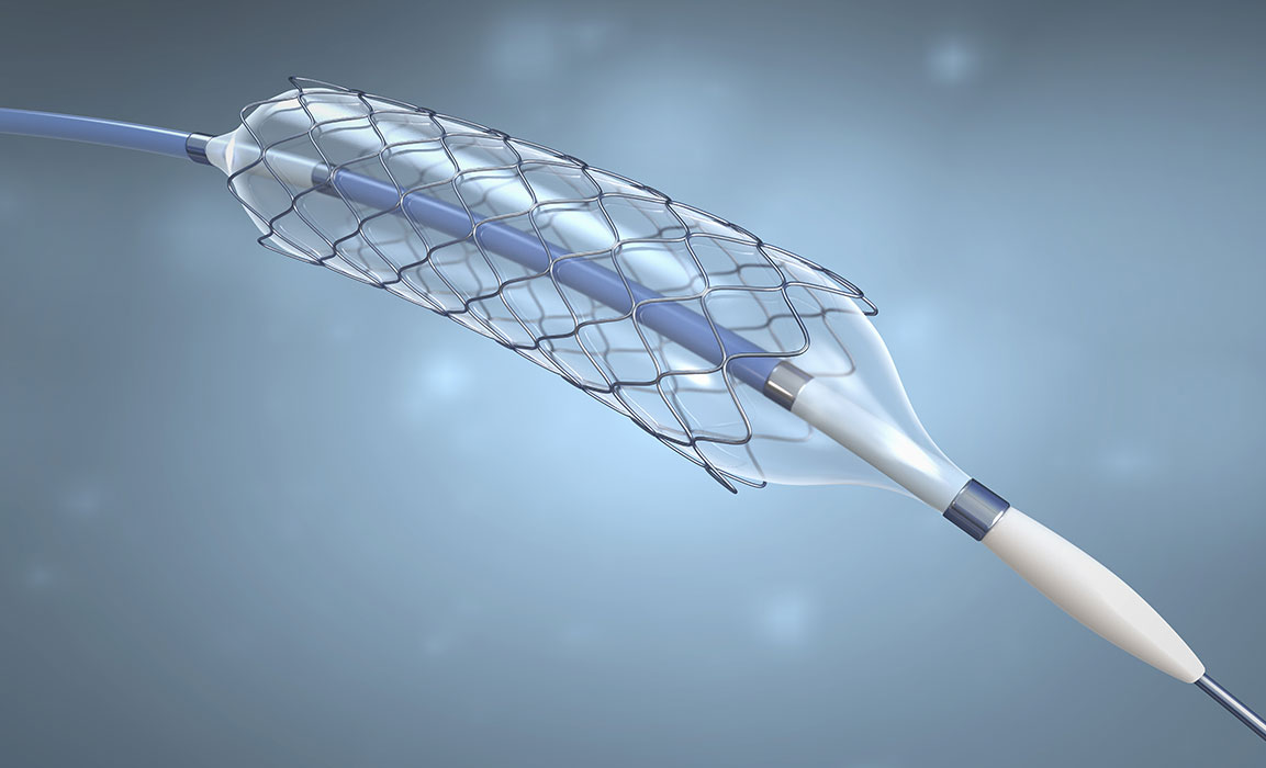 Quality inspection of the internal and external geometry of stents and vascular prostheses